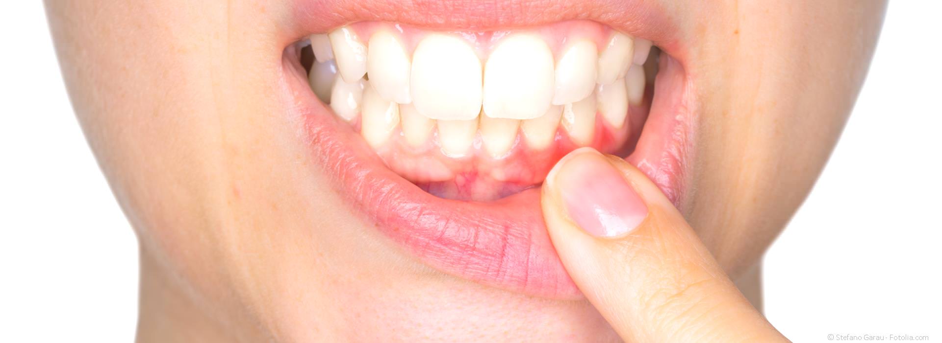 Laser gegen Herpes und Aphthen herpes, lippenherpes, aphthen