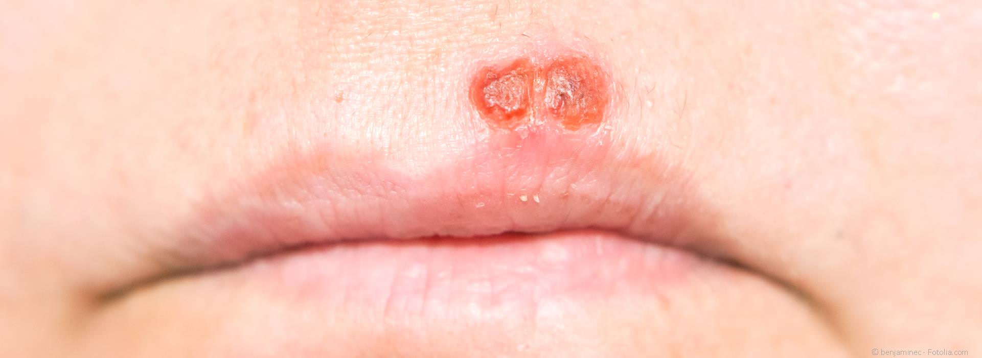 Probleme mit Lippen-Herpes und Aphthen?